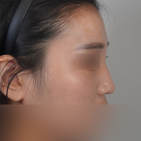 코재수술(콧대,코끝 실리콘+귀연골)