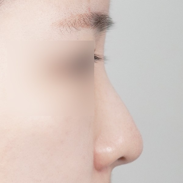코끝,비중격,귀연골,복코,매부리,절골,짧은코