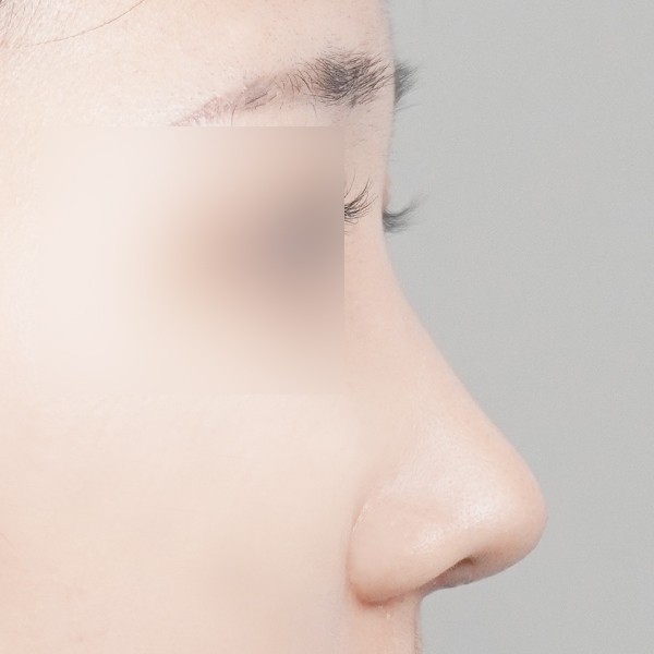 코끝,비중격,귀연골,복코,매부리,절골,짧은코