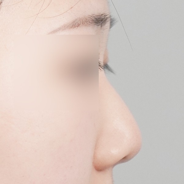 코끝,비중격,귀연골,복코,매부리,절골,짧은코